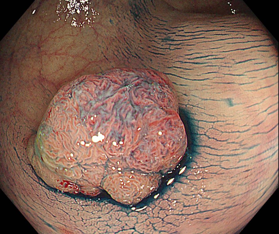 悪性腫瘍の発見・治療について