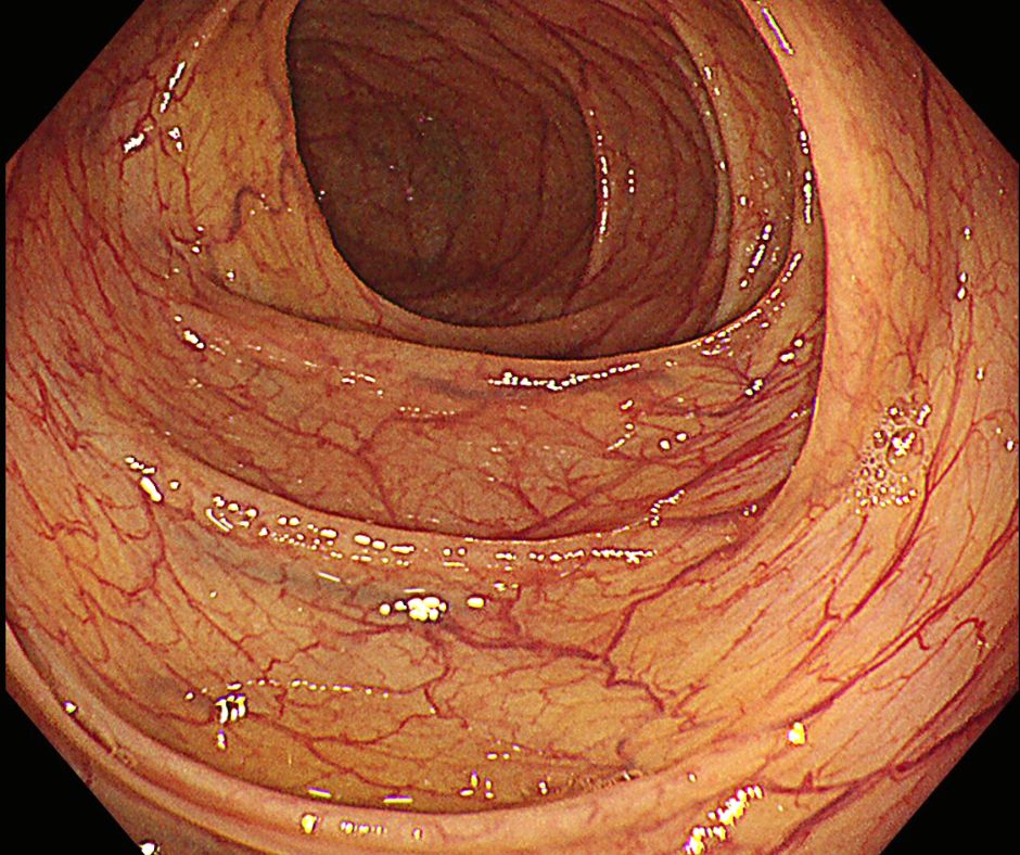 血管透見が綺麗に見えている正常な大腸粘膜