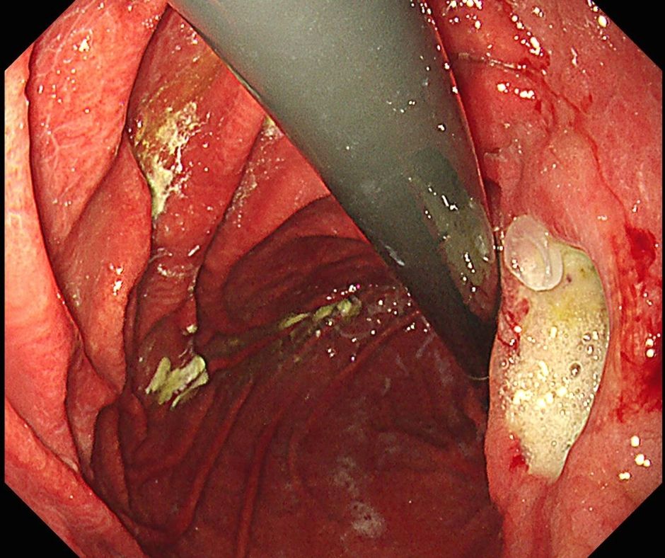 胃角部の潰瘍