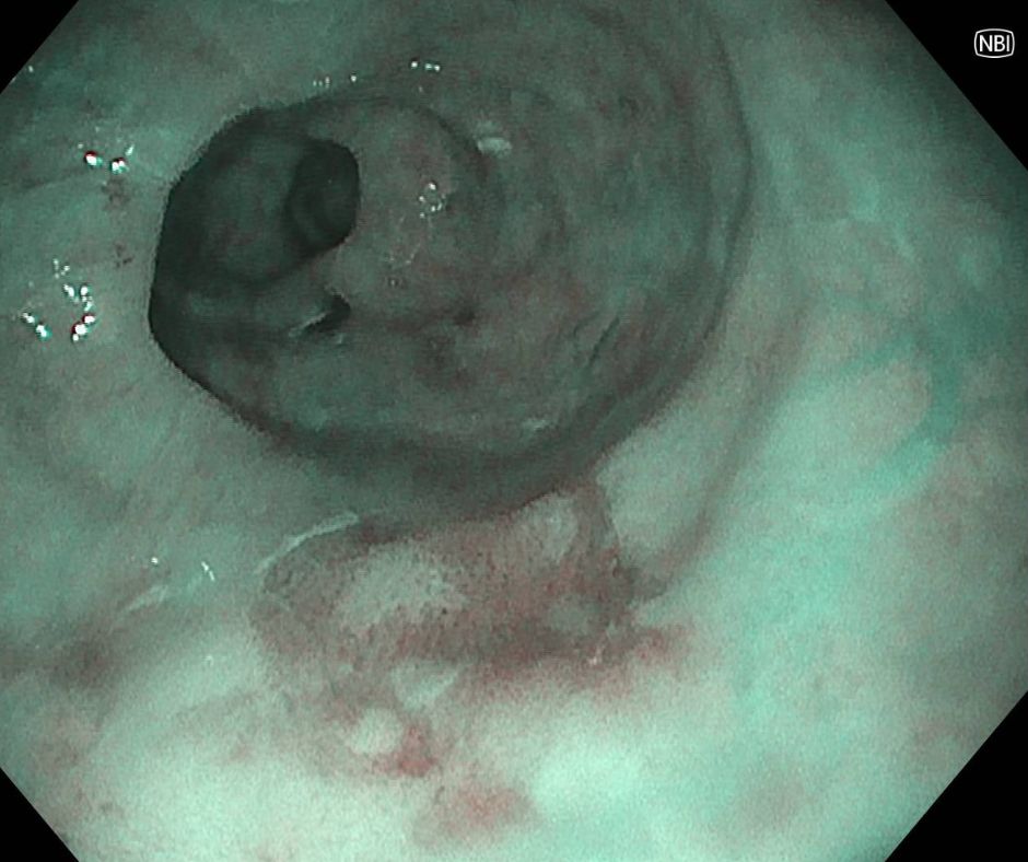 早期食道癌のＮBI画像(経鼻内視鏡)