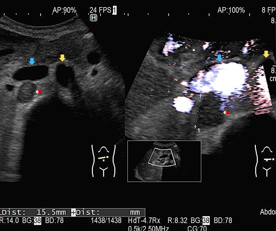 ①下大動脈(黄色矢印)周囲に腹腔内リンパ節腫脹(赤色矢印)