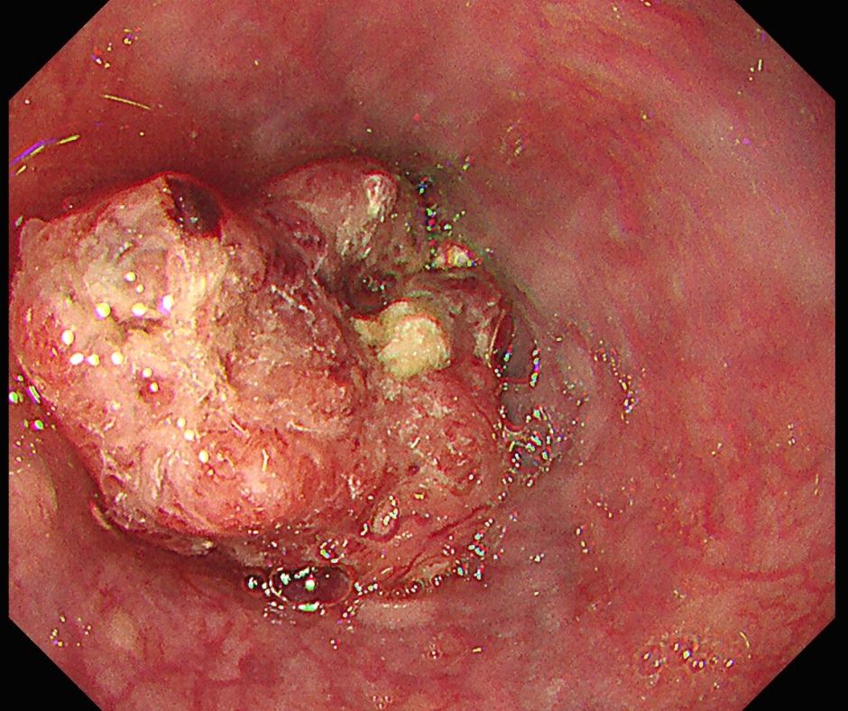 進行食道癌による全周性の食道狭窄