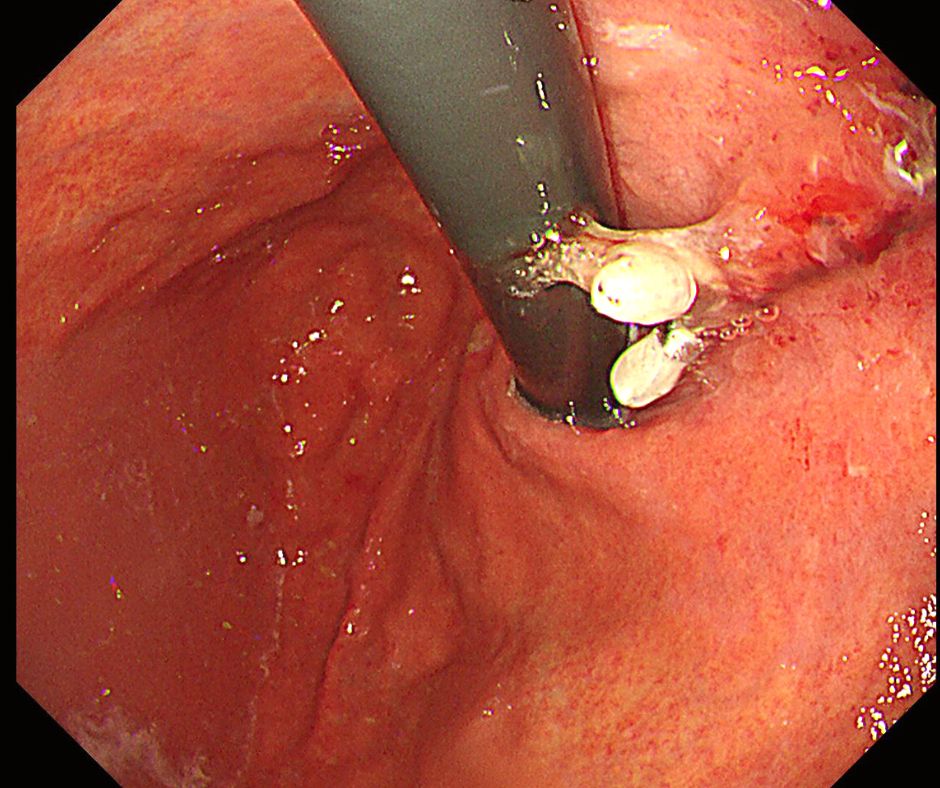 出血翌日の内視鏡で止血確認