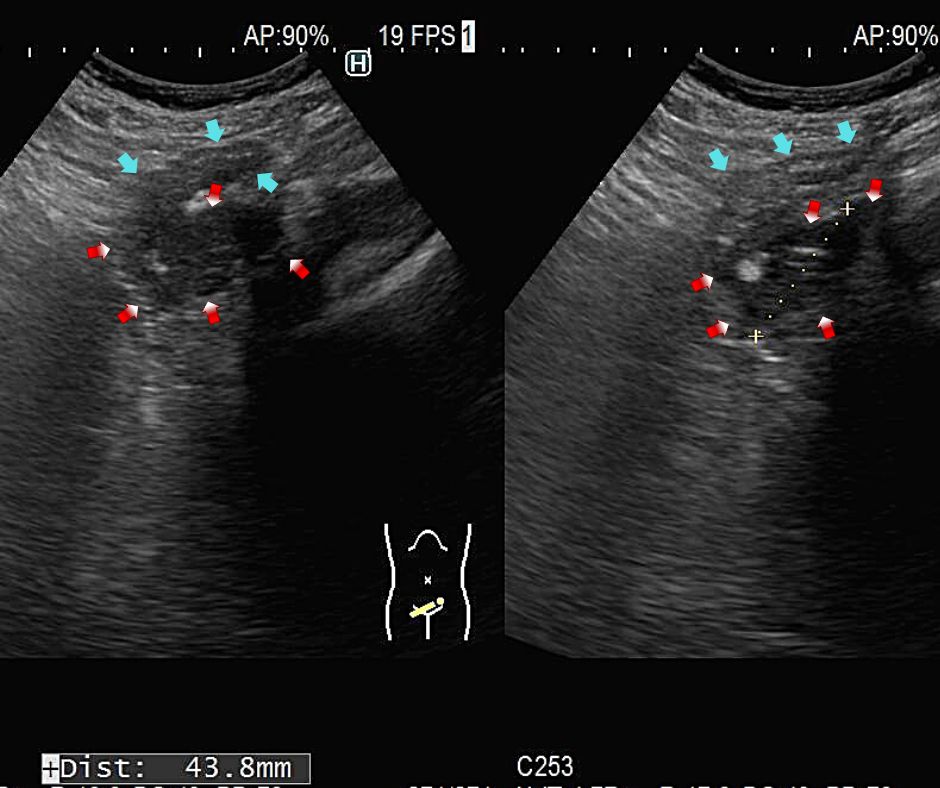 憩室炎で肥厚し硬化した大腸壁(赤色矢印)と浮腫性に肥厚した口側大腸(水色矢印)