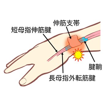 TFCC損傷