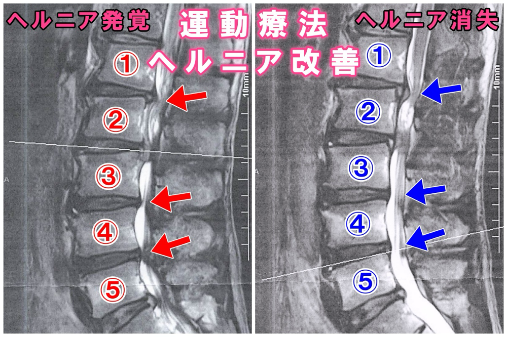 堺市　腰痛