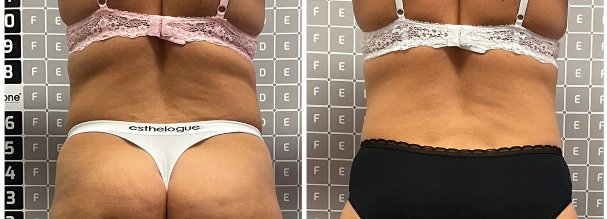 Vorher-Nachher-Dokumentation einer Liposana 3 Plus Behandlung bei Bella's Beauty in Dortmund