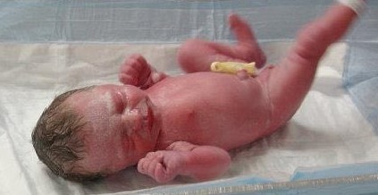 This baby was born a bit prematurely at 34 weeks of pregnancy, but was fit and healthy. Her cord was clamped with a plastic umbilical clamp. (Picture by Kristen Smith)