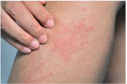 piel escamosa piernas tratamiento de diabetes