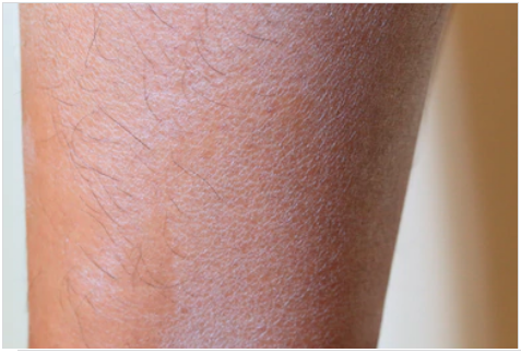 piel escamosa piernas tratamiento de diabetes piel escamosa piernas tratamiento de diabetes