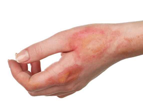 Hautverbrennungen - Das Element Feuer verstehen