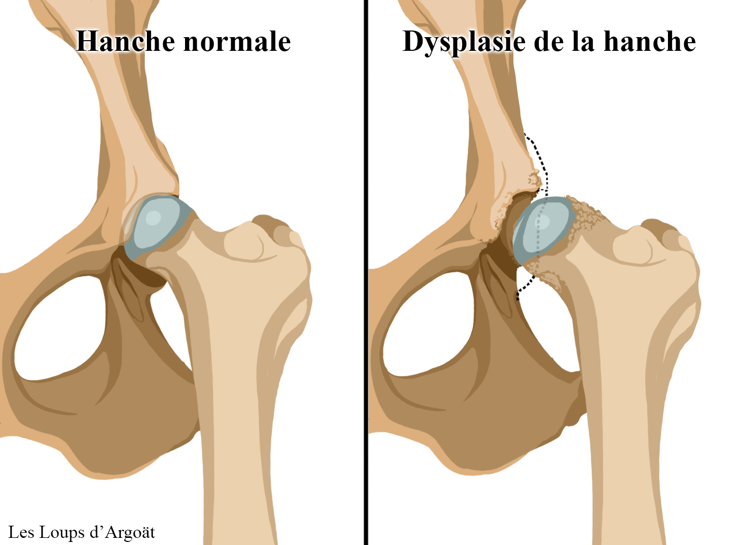 Aider la recherche sur la dysplasie de la hanche