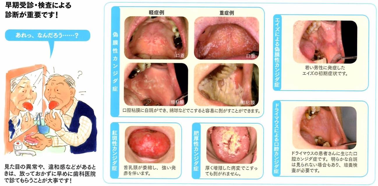 口内炎 カンジダ 性