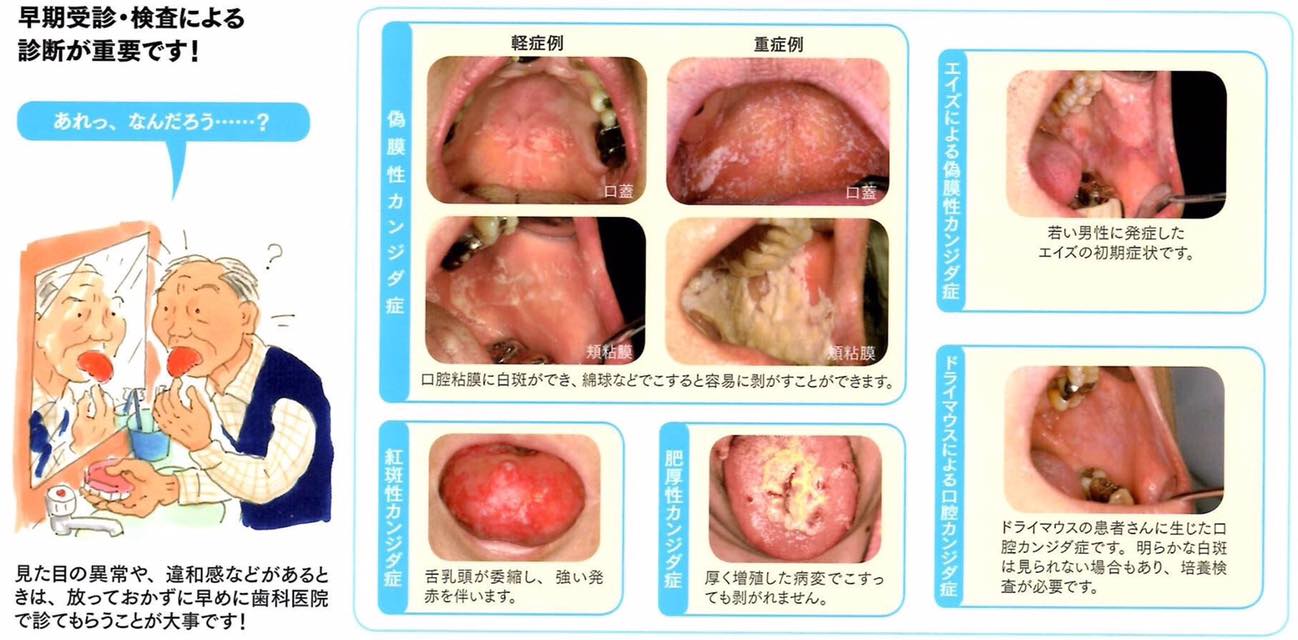 喉 に カビ が 生える 病気