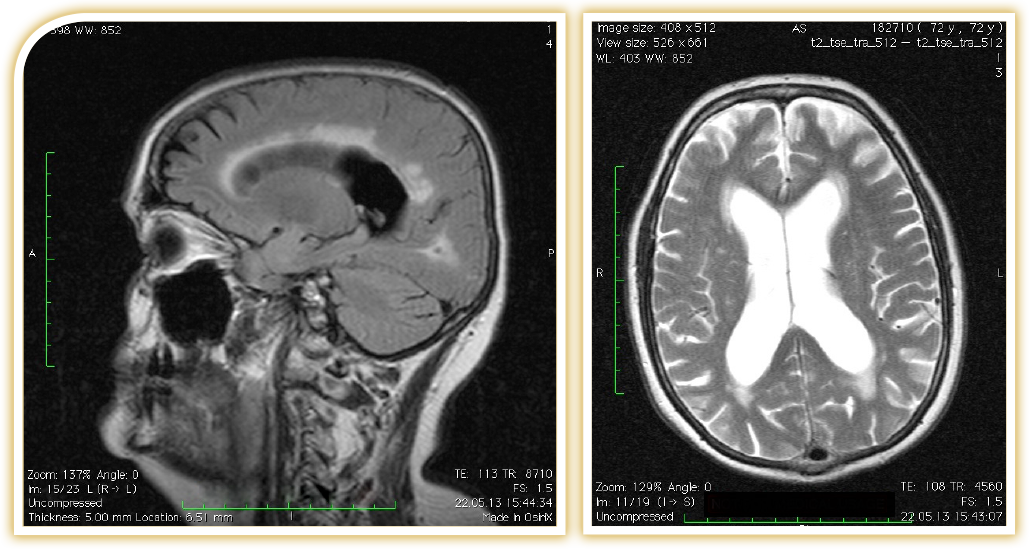 Hydrocephalus Neurochirurgie in Wiesbaden