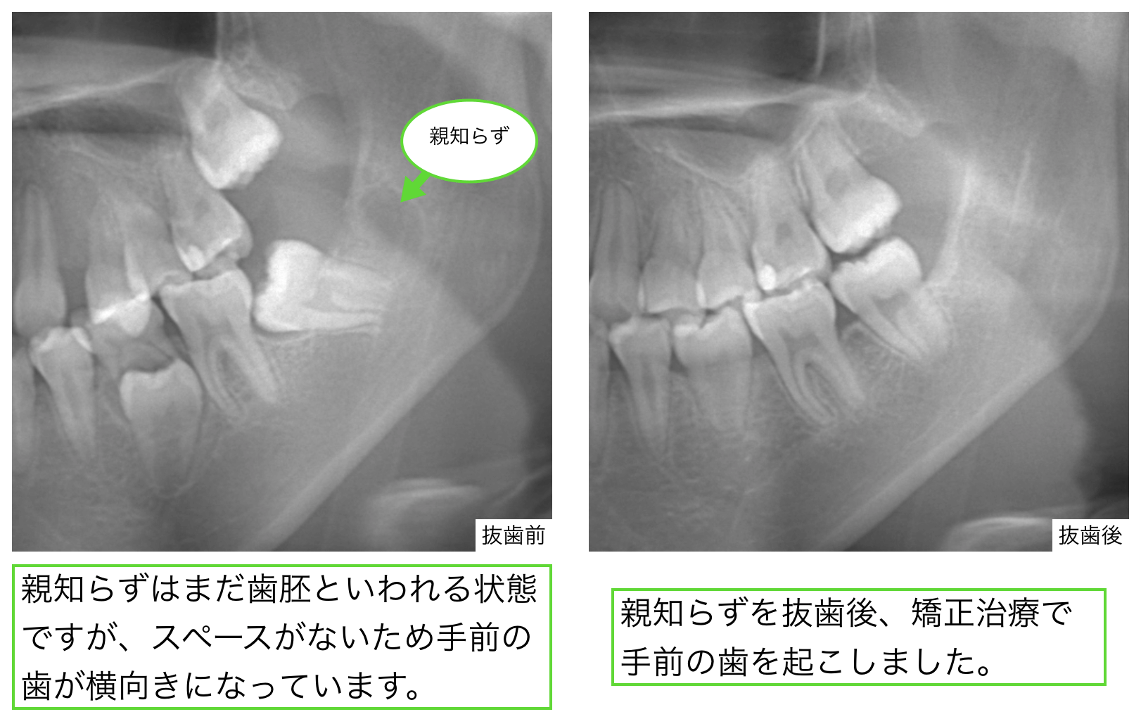 親知らず 抜歯 後 手前 の 歯 が 痛い