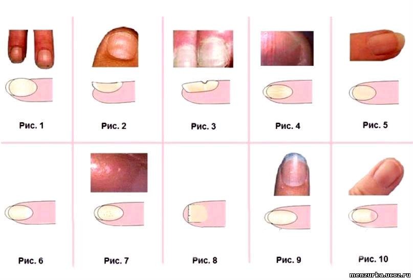 поперечные полосы на ногтях. выпуклые ногти на руках о чем говорят. синдром мари бамбергера. выпуклые ногти на руках о чем говорят. выпуклые ногти на руках о чем говорят.