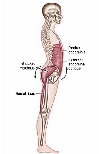 Muscle imbalances creating an anterior pelvic tilt