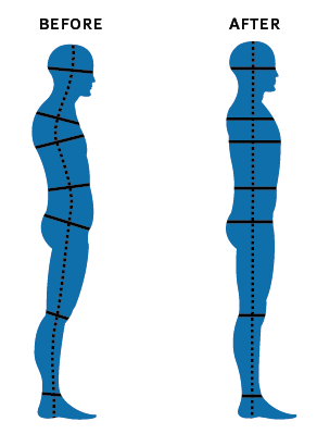 A picture of a body before (poor spinal alignment) and after rolfing (proper spinal alignment)