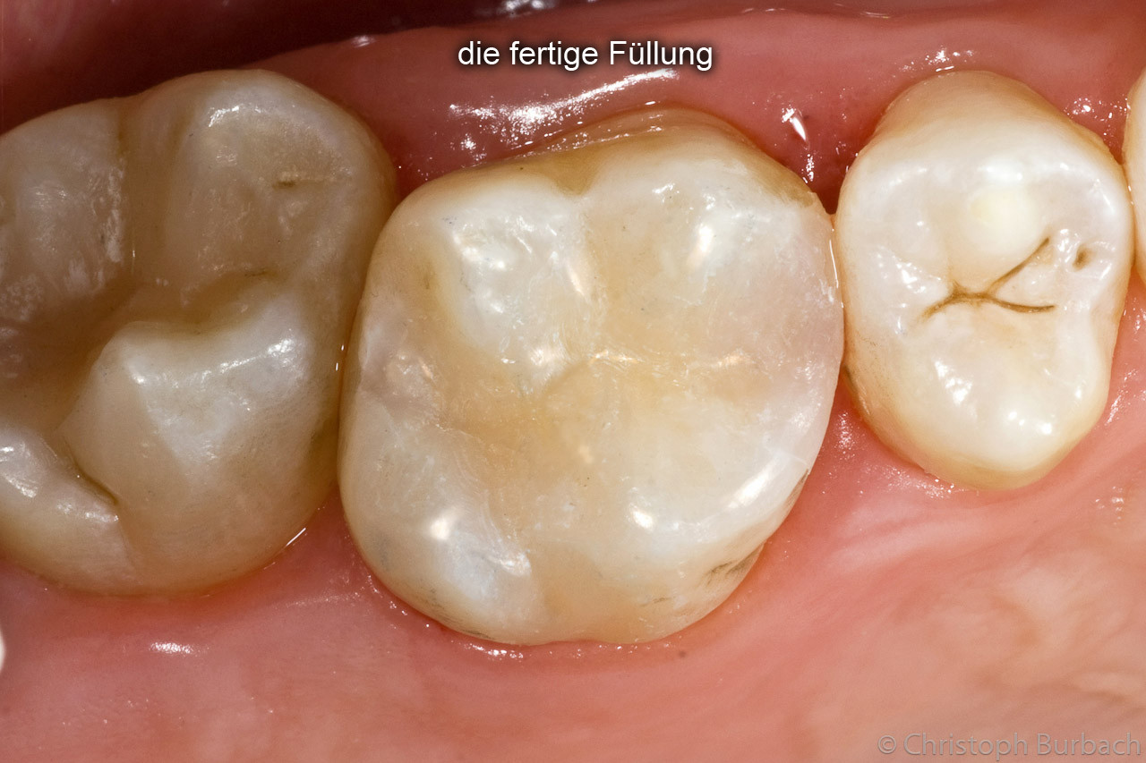 Galerie Kompositfüllungen - Burbach-Zahnarzt Groß-Umstadt Dieburg Babenhausen