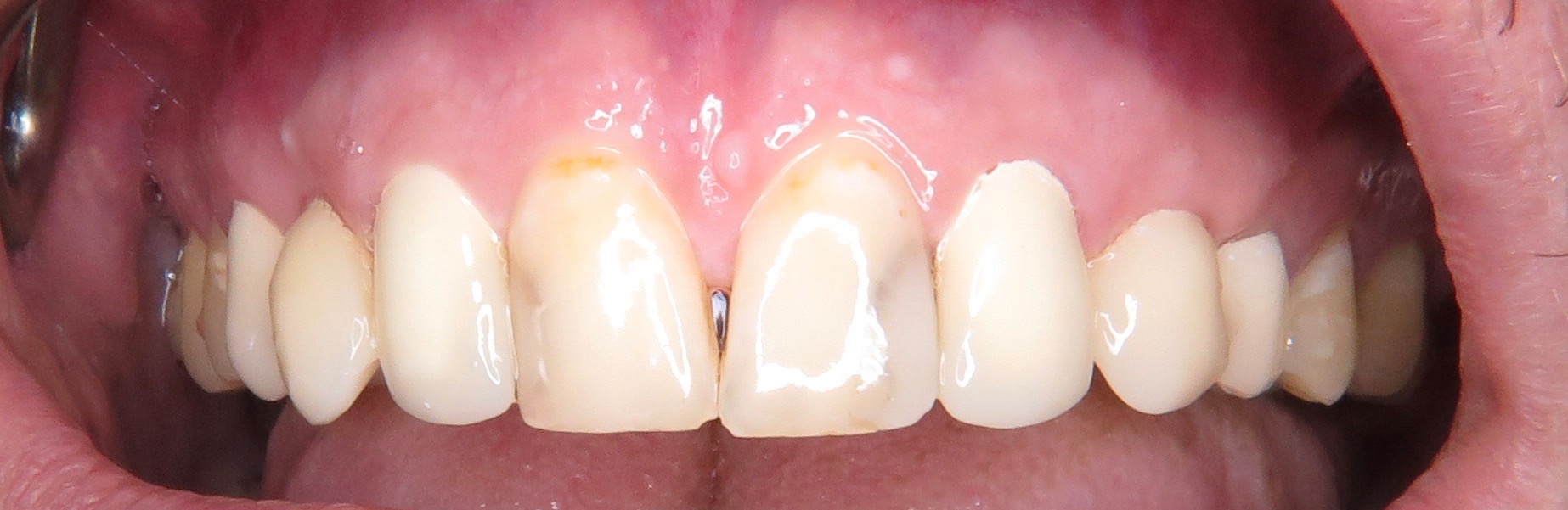 Implantat Behandlung Praxis Fur Implantologie Dr Rolf Fankidejski Mmsc