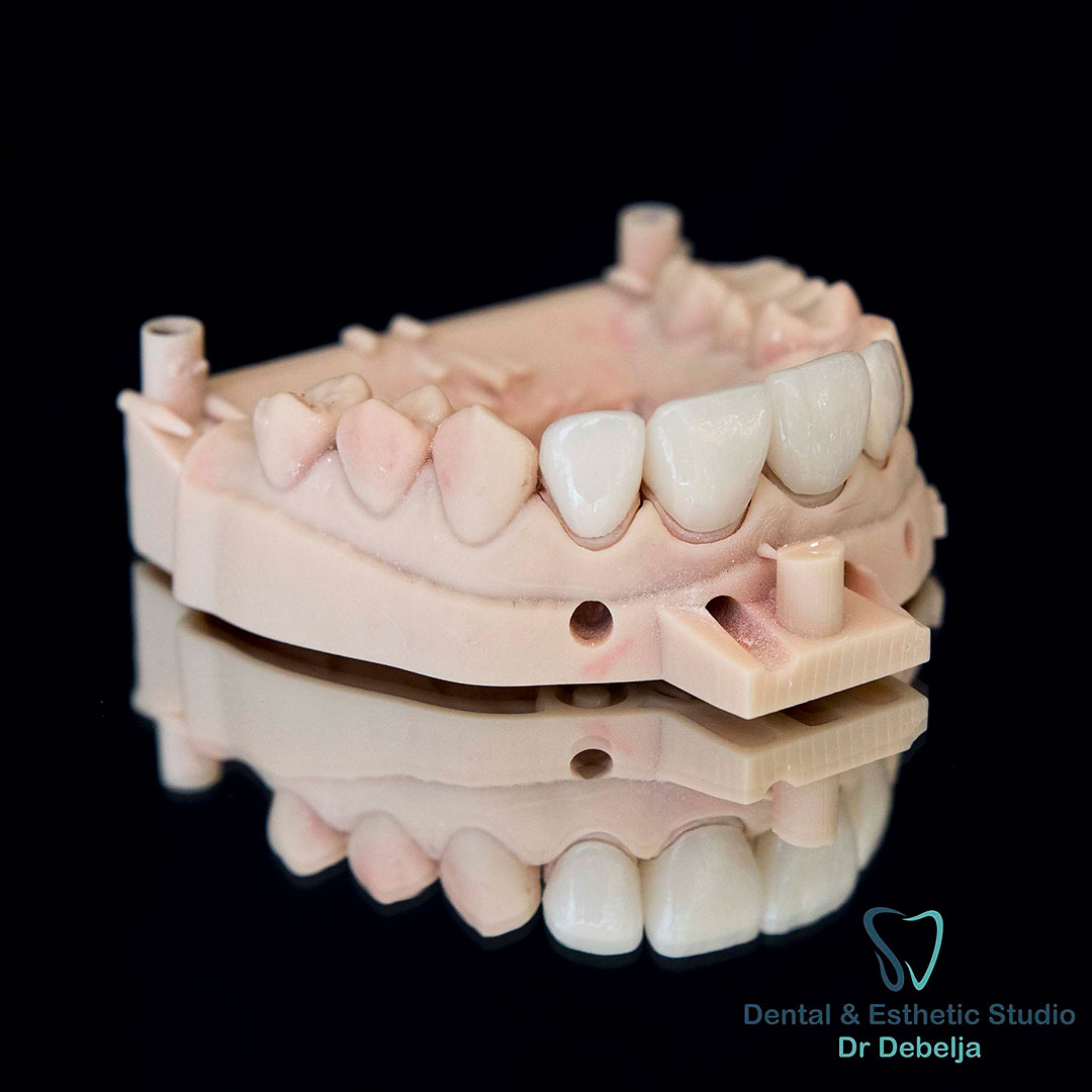 Veneers II | Dental Esthetic Studio Dr Debelja Bar Tivari Montenegro