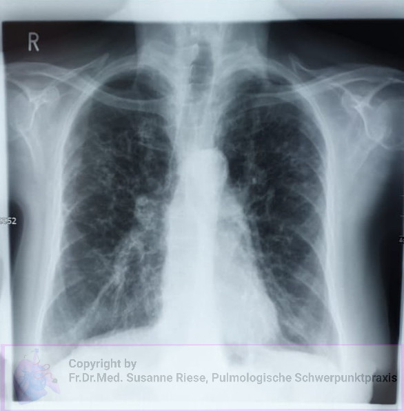 Sarkoidose mit Lungenfibrose