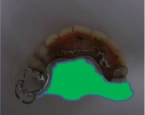 新旧義歯面積比較
