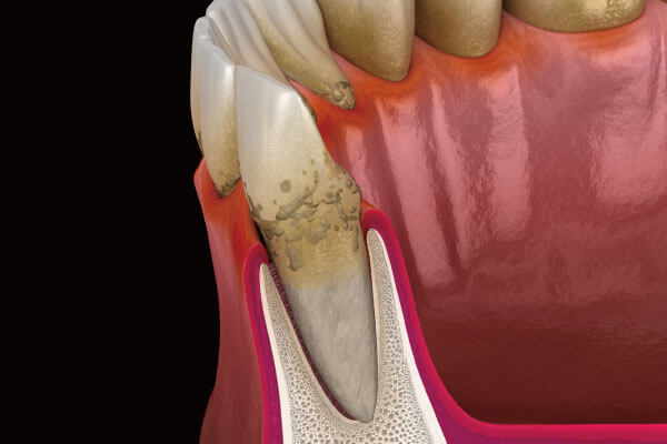 歯周病予防について
