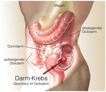 Die Hämorrhoide und die Wassergeschwulst nach der Operation die Abtragung der Hämorrhoide