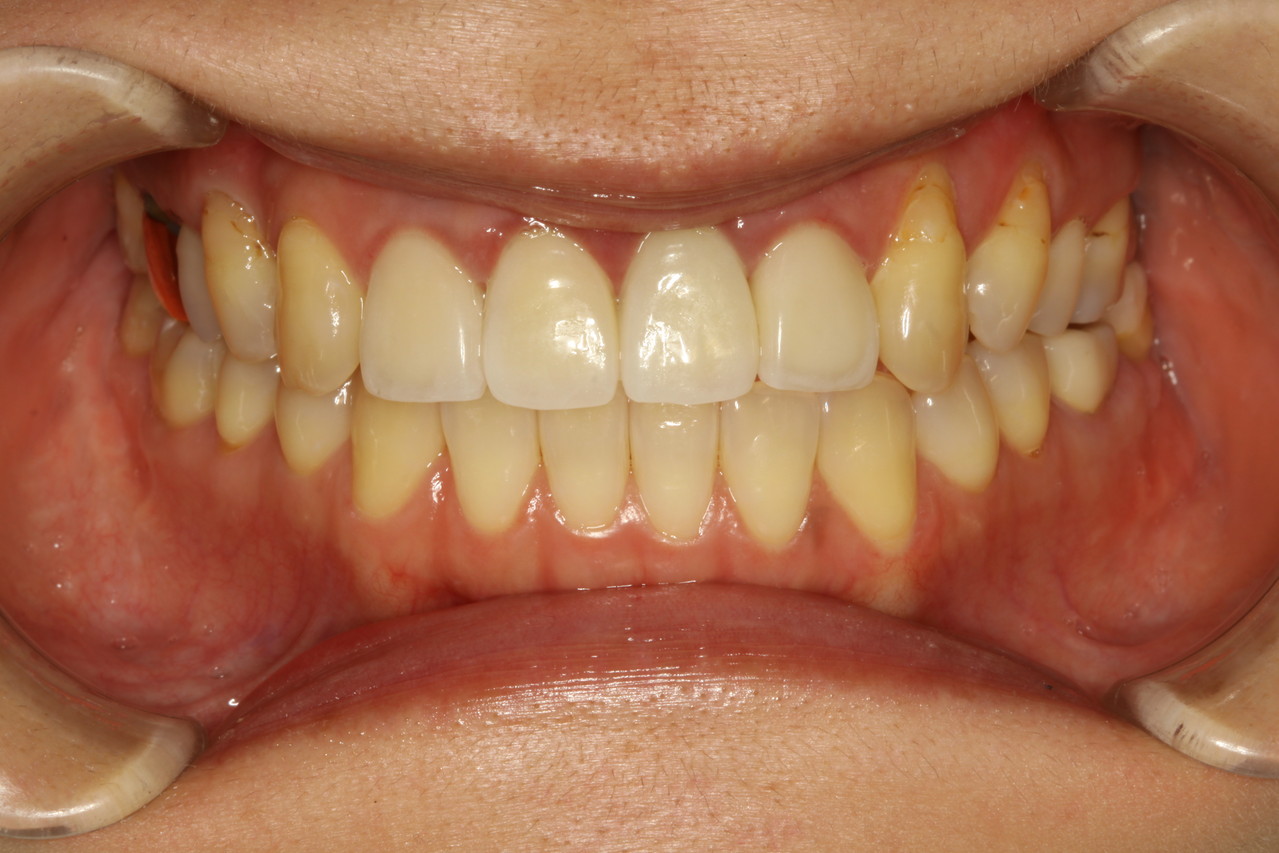 歯茎が下がってしまう方の特徴 歯周病から歯を守る