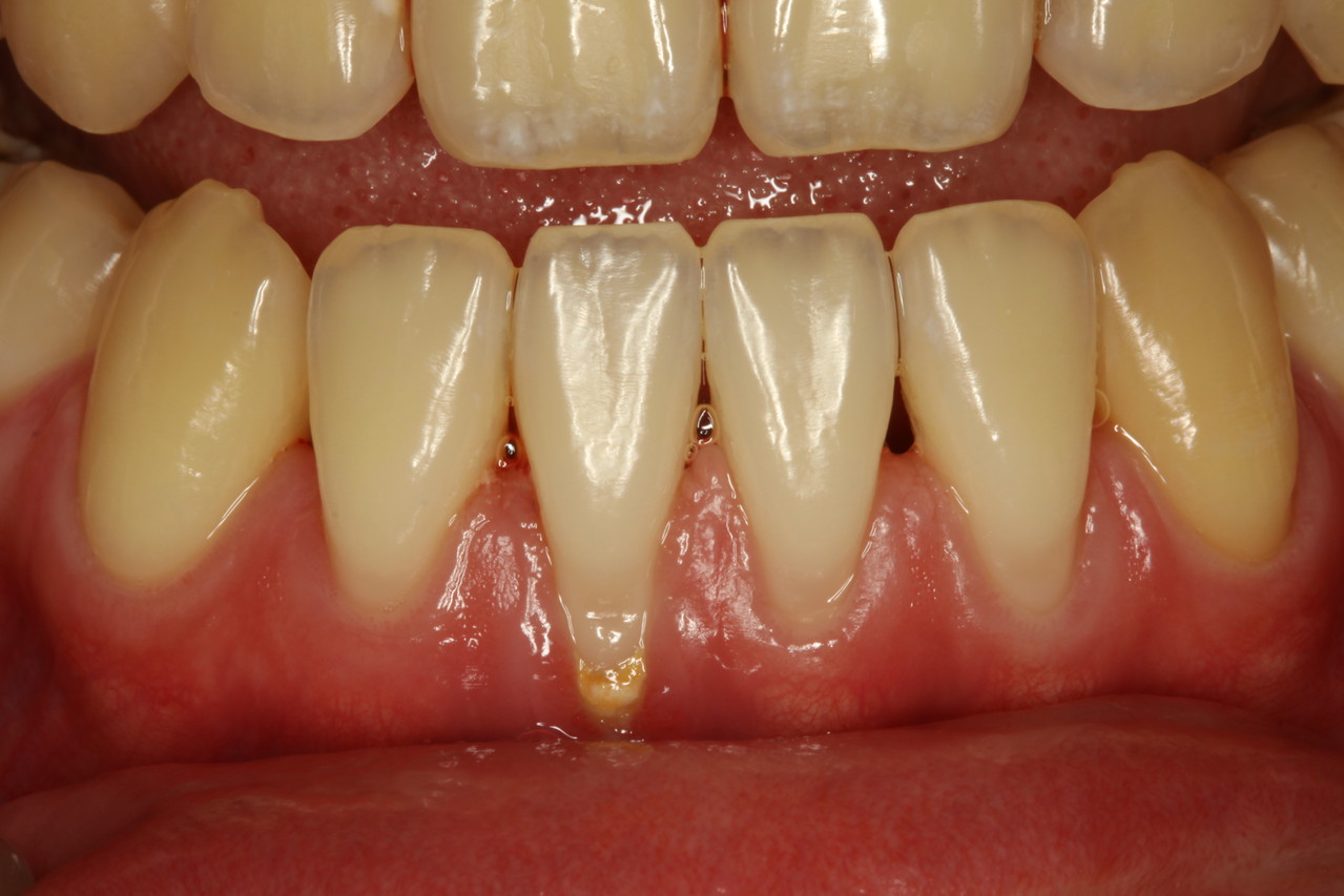 歯茎が下がってしみる場合 歯周病から歯を守る