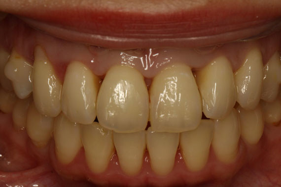 歯と歯の間の歯茎が下がることがあります 歯周病から歯を守る