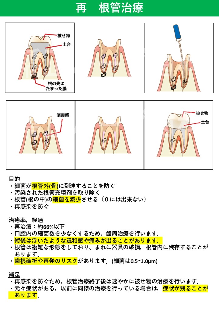 再・根管治療