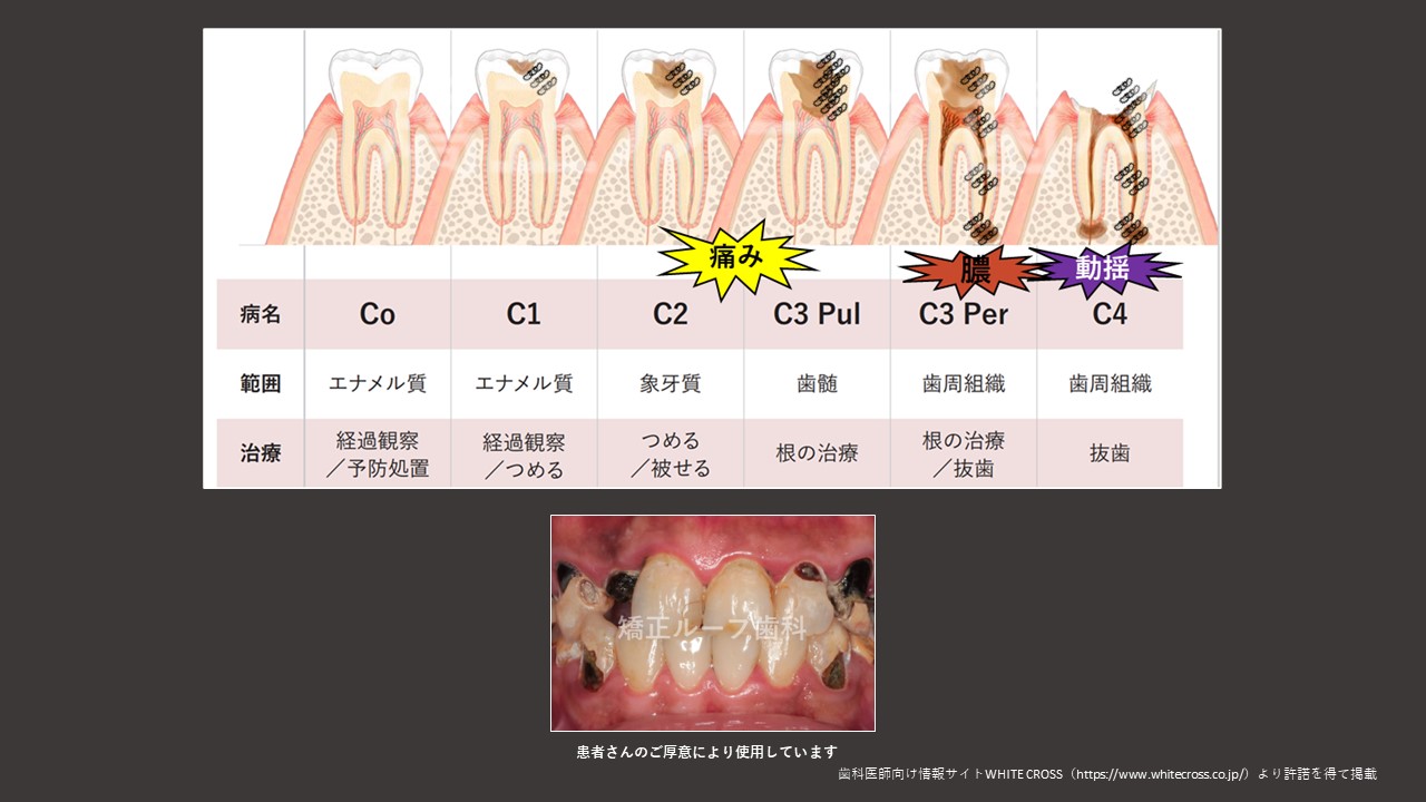 う蝕(虫歯)とは