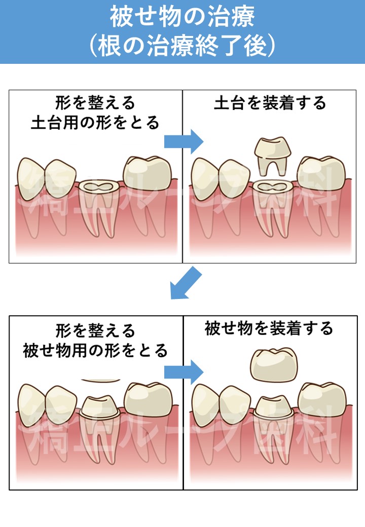 土台から被せ物の治療