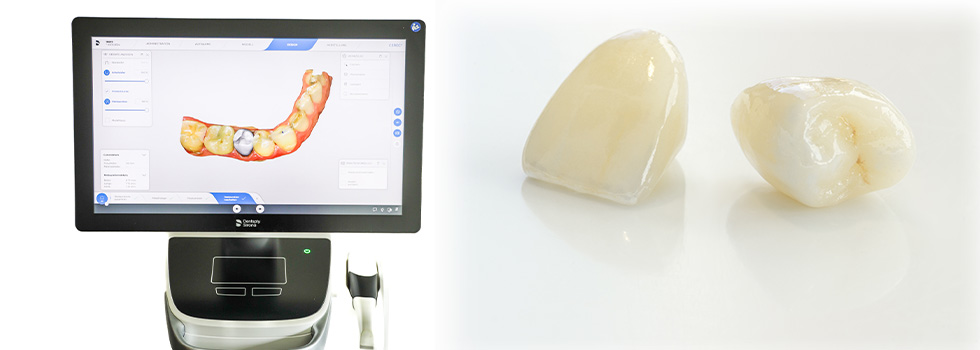 Cerec und Vollkeramik