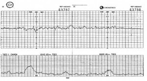 MONITOREO FETAL NST