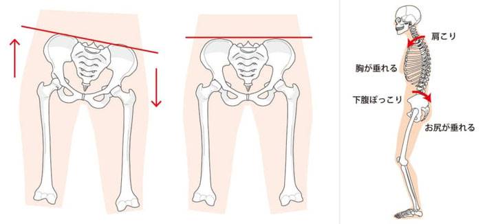 骨盤矯正が必要な場合について