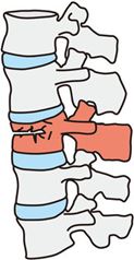 圧迫骨折後から腰痛になる