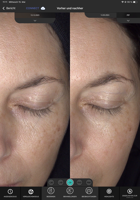 Micro Needling bei Trockener Haut und Falten