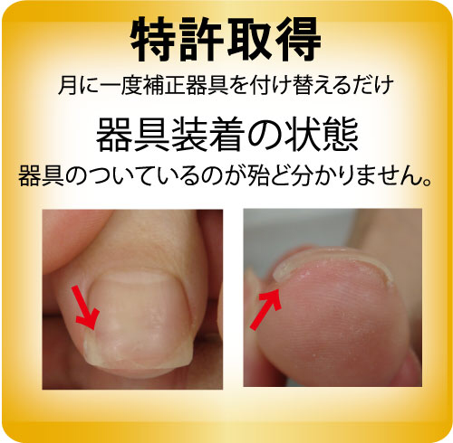 巻き爪補正 - 昭栄堂スポーツ鍼灸接骨院