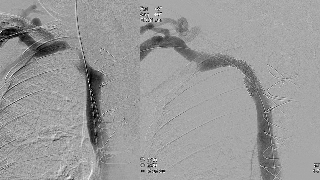 Endovascular hemodialysis access management: The important role of IR