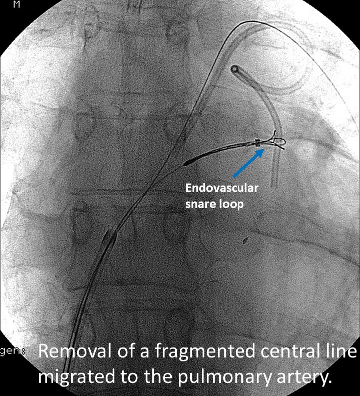 Management of complications in Interventional Radiology