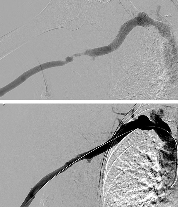 Angioplasty of an arteriovenous fistula stenosis