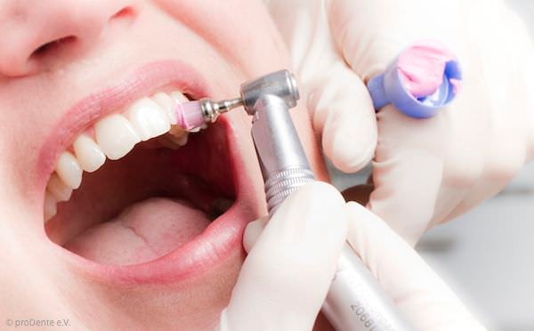 Politur der Zähne für glatte Oberflächen bei der professionellen Zahnreinigung