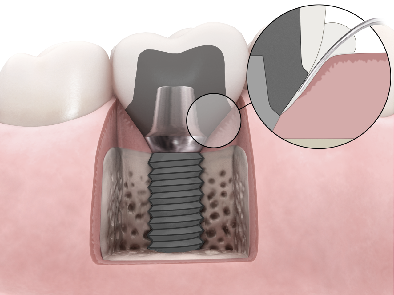 Dentsply Implants Nikolaus Zahntechnik GmbH