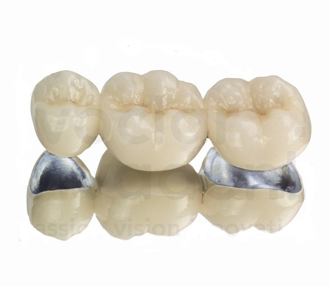 Prótesis Fija de Metal Porcelana