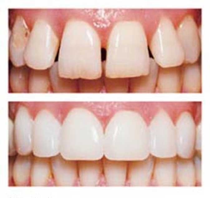 Coronas de Zirconia (Odontología Cosmética)