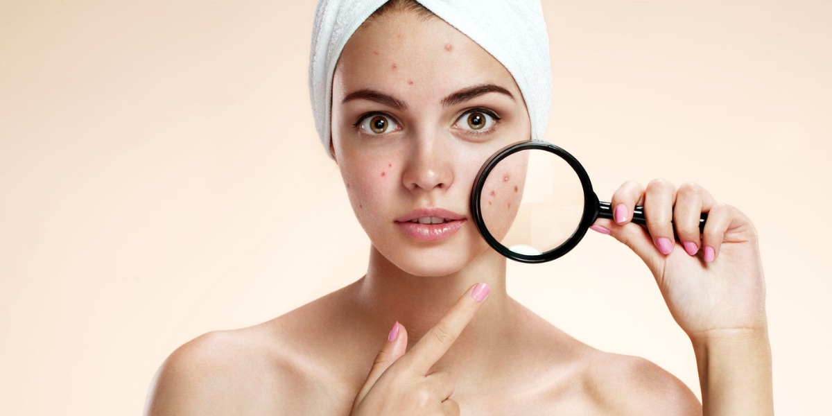 Décryptons l'acné avec la naturopathie